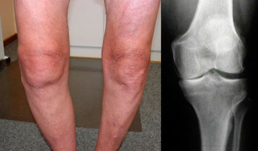 artróza kolenního kloubu