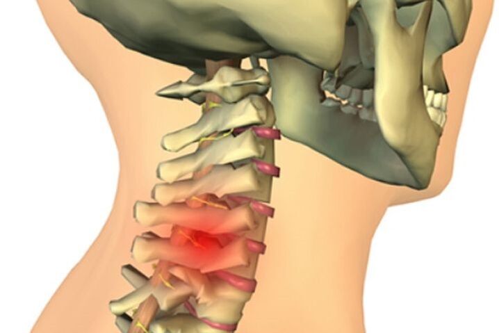 bolest krku v důsledku osteoartrózy