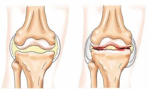 zdravý a artrotický kolenní kloub